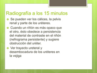 Radiografía a los 15 minutos
 Se pueden ver los cálices, la pelvis
renal y parte de los uréteres.
 Cuando un riñón es más opaco que
el otro, ésto obedece a persistencia
del material de contraste en el riñón
(nefrograma persistente) y sugiere
obstrucción del uréter.
 Ver trayecto ureteral y
desembocadura de los uréteres en
la vejiga
 