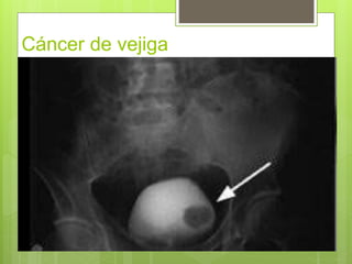 Cáncer de vejiga
 