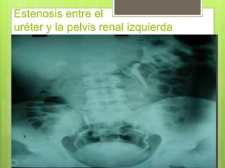 Estenosis entre el
uréter y la pelvis renal izquierda
 