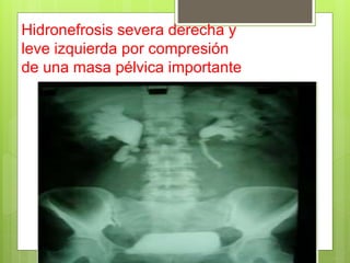 Hidronefrosis severa derecha y
leve izquierda por compresión
de una masa pélvica importante
 