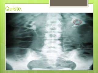 Quiste.
 