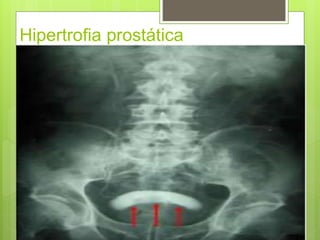 Hipertrofia prostática
 