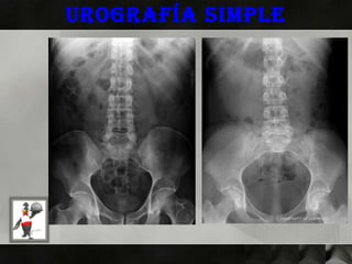 Urografía simple
 