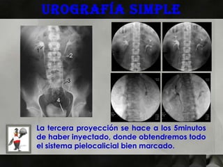 Urografía simple




La tercera proyección se hace a los 5minutos
de haber inyectado, donde obtendremos todo
el sistema pielocalicial bien marcado.
 