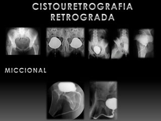 Urografia excretora