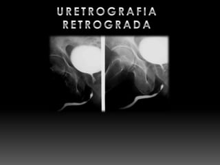 Urografia excretora