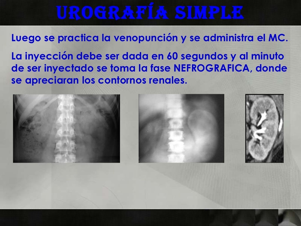 Urografia excretora