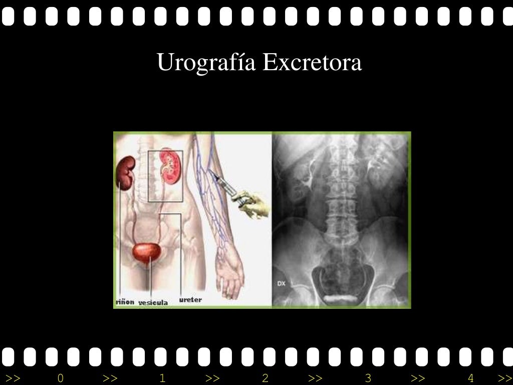 Urografia excretora