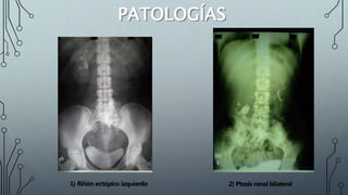 PATOLOGÍAS
1) Riñón ectópico izquierdo 2) Ptosis renal bilateral
 
