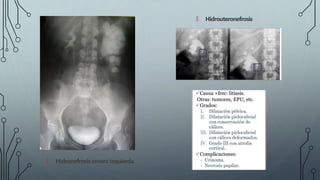 🠶 Hidronefrosis severa izquierda
🠶 Hidrouteronefrosis
 