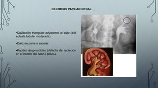 NECROSIS PAPILAR RENAL
•Cavitación triangular adyacente al cáliz (d/d
ectasia tubular moderada).
•Cáliz en porra o sacular.
•Papilas desprendidas (defecto de repleción
en el interior del cáliz o pelvis).
 