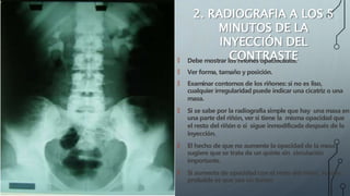 🠶 Debe mostrar los riñones opacificados.
🠶 Ver forma, tamaño y posición.
🠶 Examinar contornos de los riñones: si no es liso,
cualquier irregularidad puede indicar una cicatriz o una
masa.
🠶 Si se sabe por la radiografía simple que hay una masa en
una parte del riñón, ver si tiene la misma opacidad que
el resto del riñón o si sigue inmodificada después de la
inyección.
🠶 El hecho de que no aumente la opacidad de la masa
sugiere que se trata de un quiste sin circulación
importante.
🠶 Si aumenta de opacidad con el resto del riñón, lo más
probable es que sea un tumor.
2. RADIOGRAFIA A LOS 5
MINUTOS DE LA
INYECCIÓN DEL
CONTRASTE
 