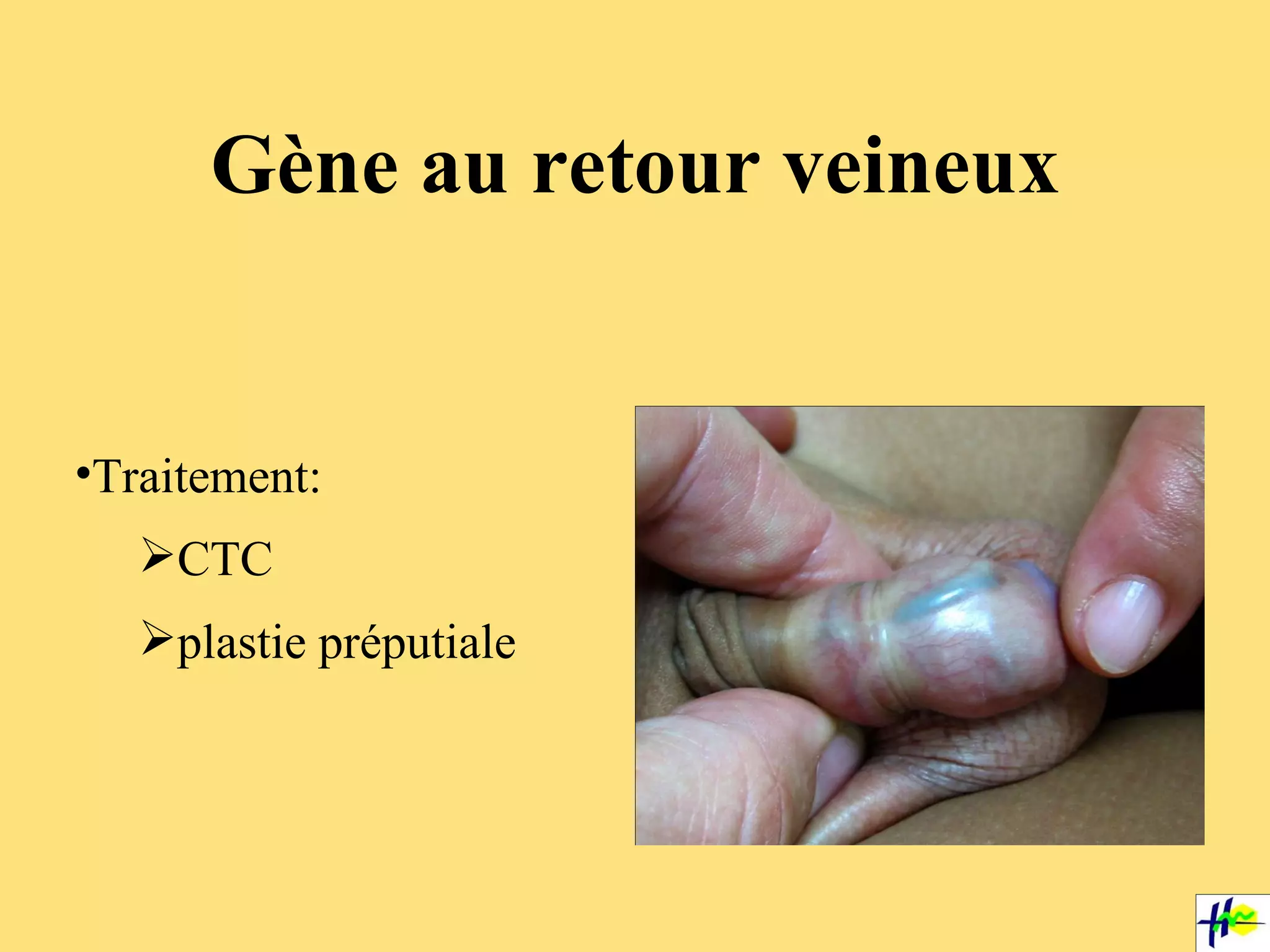 Gène au retour veineux Traitement:  CTC plastie préputiale 