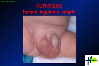 CLINIQUE hernie inguinale simple 