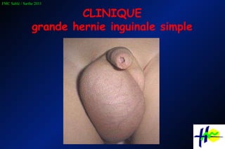 CLINIQUE grande hernie inguinale simple 