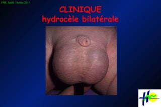 CLINIQUE hydrocèle bilatérale 