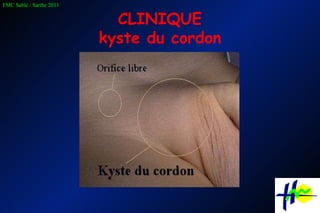 CLINIQUE kyste du cordon 