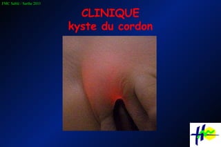 CLINIQUE kyste du cordon 