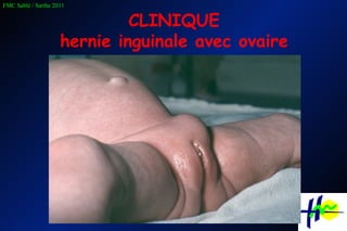 CLINIQUE hernie inguinale avec ovaire 