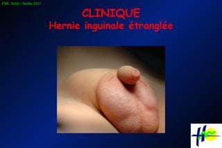 CLINIQUE Hernie inguinale étranglée 