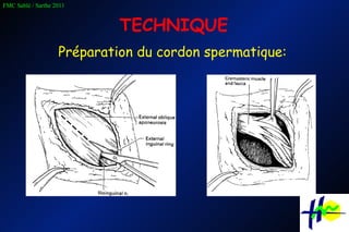 TECHNIQUE Préparation du cordon spermatique: 