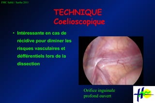 Intéressante en cas de récidive pour diminer les risques vasculaires et défférentiels lors de la dissection TECHNIQUE Coelioscopique Orifice inguinale profond ouvert 