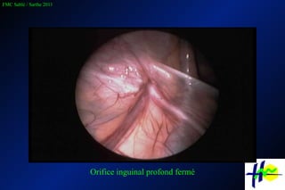 Orifice inguinal profond fermé 