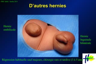 D’autres hernies Hernie  ombilicale Hernie  Inguinale bilatérale Régression habituelle sauf majeure, chirurgie rare et tardive (3 à 5 ans) 