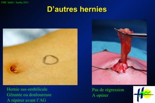 D’autres hernies Hernie sus-ombilicale Gênante ou douloureuse A répérer avant l’AG Pas de régression A opérer 