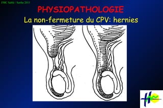 La non-fermeture du CPV: hernies PHYSIOPATHOLOGIE 
