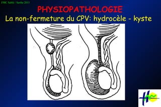 La non-fermeture du CPV: hydrocèle - kyste PHYSIOPATHOLOGIE 