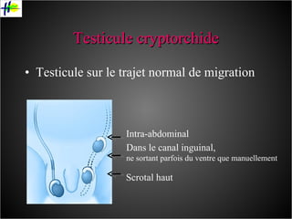 Testicule cryptorchide Testicule sur le trajet normal de migration Intra-abdominal Dans le canal inguinal,  ne sortant parfois du ventre que manuellement Scrotal haut 