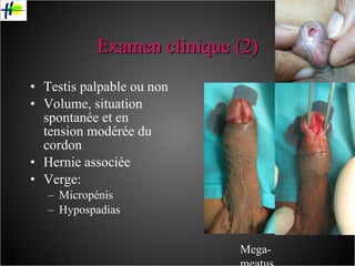 Examen clinique (2) Testis palpable ou non Volume, situation spontanée et en tension modérée du cordon Hernie associée Verge: Micropénis Hypospadias Mega-meatus 