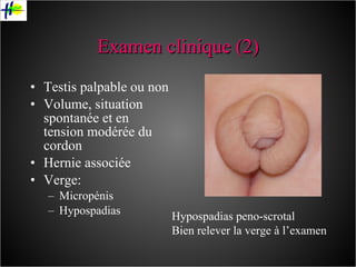 Examen clinique (2) Testis palpable ou non Volume, situation spontanée et en tension modérée du cordon Hernie associée Verge: Micropénis Hypospadias Hypospadias peno-scrotal Bien relever la verge à l’examen 
