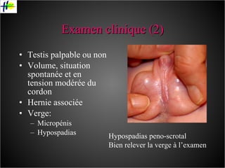 Examen clinique (2) Testis palpable ou non Volume, situation spontanée et en tension modérée du cordon Hernie associée Verge: Micropénis Hypospadias Hypospadias peno-scrotal Bien relever la verge à l’examen 