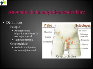 Anomalie de la migration testiculaire Définitions Ectopie Anomalie de la migration en dehors de son trajet normal Testicule palpable Cryptorchidie Arrêt de la migration sur son trajet normal 