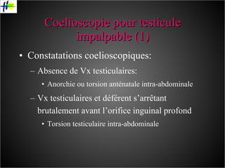 Coelioscopie pour testicule impalpable (1) Constatations coelioscopiques: Absence de Vx testiculaires:  Anorchie ou torsion anténatale intra-abdominale Vx testiculaires et déférent s’arrêtant brutalement avant l’orifice inguinal profond Torsion testiculaire intra-abdominale 