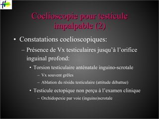 Coelioscopie pour testicule impalpable (2) Constatations coelioscopiques: Présence de Vx testiculaires jusqu’à l’orifice inguinal profond: Torsion testiculaire anténatale inguino-scrotale Vx souvent grêles Ablation du résidu testiculaire (attitude débattue) Testicule ectopique non perçu à l’examen clinique Orchidopexie par voie (inguino)scrotale 