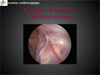 Vaisseaux testiculaires  et déférents normaux Exploration coelioscopique 