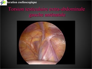 Torsion testiculaire extra-abdominale  gauche anténatale Exploration coelioscopique 