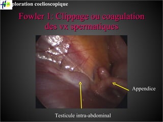 Fowler 1: Clippage ou coagulation des vx spermatiques Testicule intra-abdominal Appendice Exploration coelioscopique 