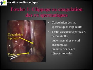 Fowler 1: Clippage ou coagulation des vx spermatiques Coagulation des vx spermatiques trop courts Testis vascularisé par les A déférentielles, gubernaculaires et evtl anastomoses crémastériennes et rétropéritonéales Coagulation  bipolaire Exploration coelioscopique Testis 
