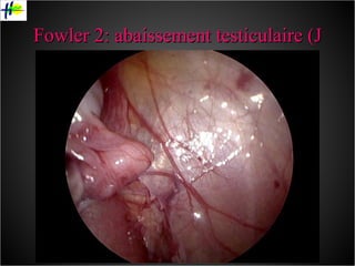 Fowler 2: abaissement testiculaire (J + 4 mois) 
