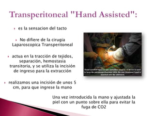 es la sensacion del tactoNo difiere de la cirugiaLaparoscopicaTransperitonealactua en la tracción de tejidos, separación, hemostasia transitoria, y se utiliza la incisión de ingreso para la extracciónrealizamos una incisión de unos 5 cm, para que ingrese la manoTransperitoneal "HandAssisted":Una vez introducida la mano y ajustada la piel con un punto sobre ella para evitar la fuga de CO2