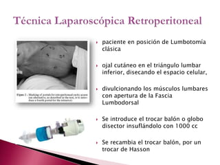 paciente en posición de Lumbotomía clásicaojal cutáneo en el triángulo lumbar inferior, disecando el espacio celular, divulcionando los músculos lumbares con apertura de la FasciaLumbodorsalSe introduce el trocar balón o globo disector insuflándolo con 1000 ccSe recambia el trocar balón, por un trocar de HassonTécnica Laparoscópica Retroperitoneal