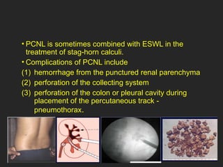 urolithasis - It's Pathogenesis and management.pptx
