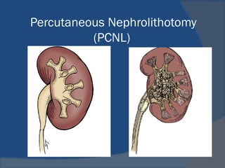 Urolithiasis -Modern Management | PPT