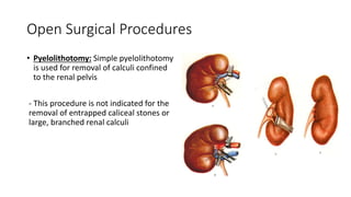 UROLITHIASIS.pptx