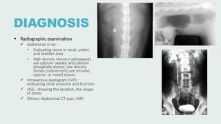 DIAGNOSIS
 Radiographic examination
 Abdominal X-ray :
• Evaluating stone in renal, ureter,
and bladder area
• High density stones (radiopaque)
are calcium oxalate and calcium
phosphate stones; low density
stones (radiolucent) are struvite,
cystine, or mixed stones
 Intravenous pyelogram (IVP) :
evaluating renal anatomy and function
 USG : showing the location, the shape
of stone
 Others: Abdominal CT scan, MRI
 