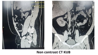 Non contrast CT KUB
 